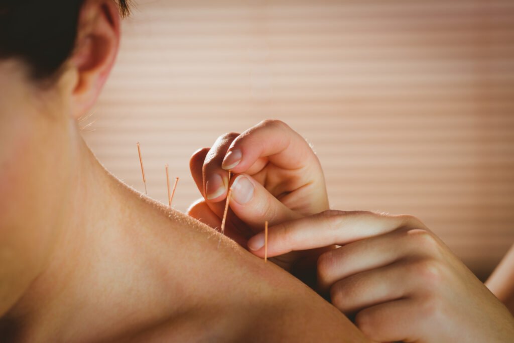 Balance Acupuncture