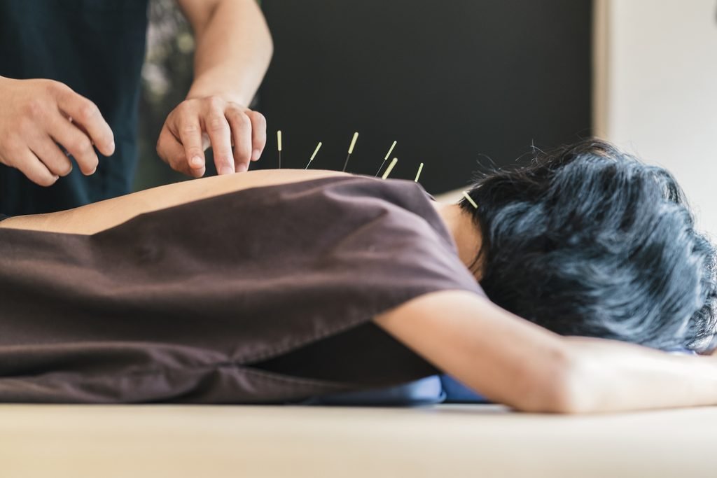 acupuncture for backpain
